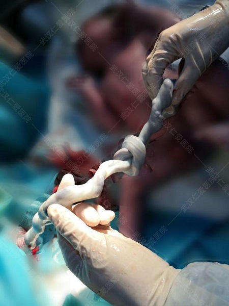 胎兒太調(diào)皮，竟在媽媽肚子里面將臍帶打了個結(jié)！