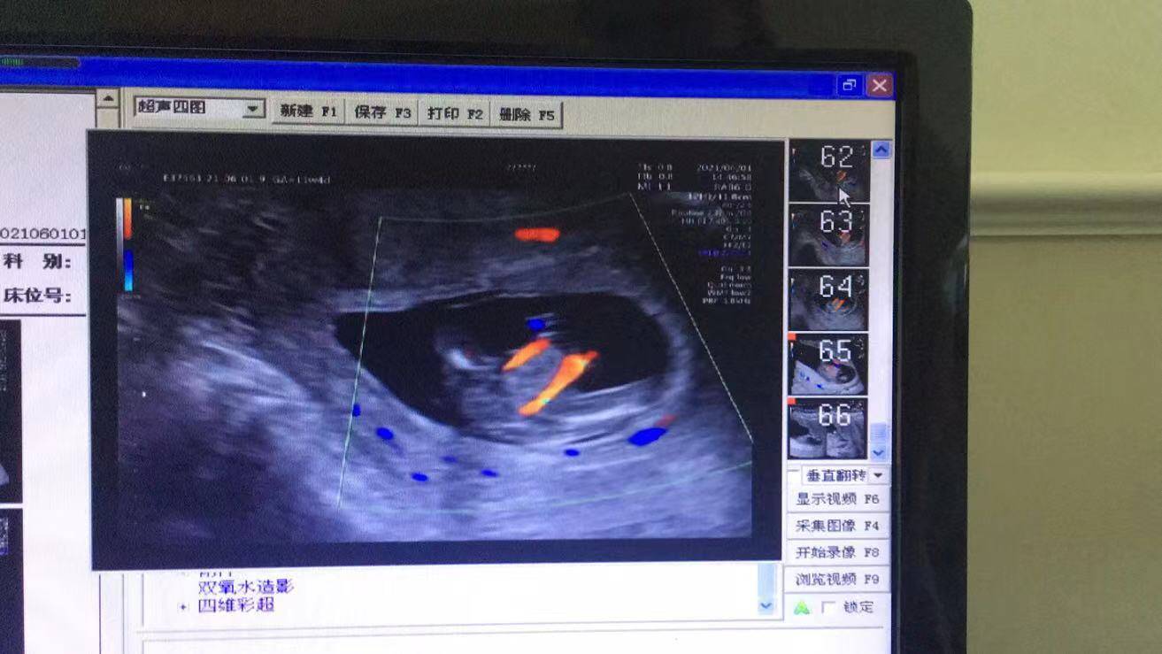 NT篩查出胎兒多發(fā)畸形，準媽媽無奈終止妊娠